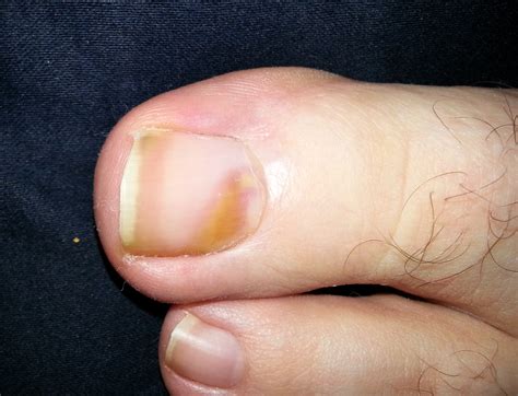symptoms of melanoma toenail